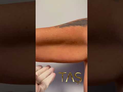 Scarless ArmLift by Dr. Suleyman TAS