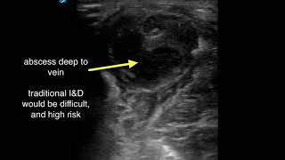 Abscess Deep to Superficial Phlebitis