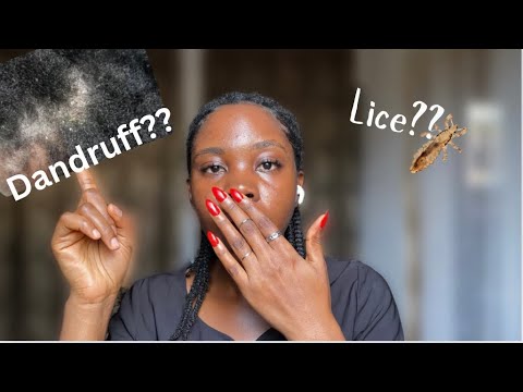 HOW TO deal with Dandruff, Itchy scalp and lice | Hair issues series [i]