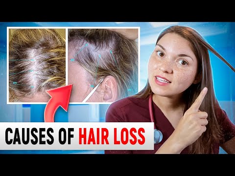 What HAIR LOSS Says About Your HEALTH: Top 15 Causes of Hair Loss (Doctor Explains)