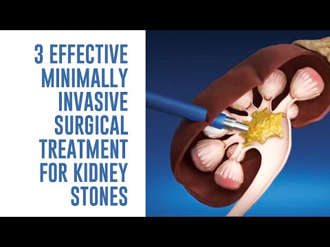 3 Effective Minimally Invasive Surgical Treatment For Kidney Stones - Adam Oppenheim