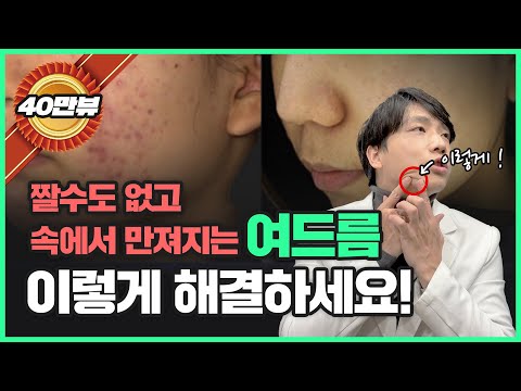 짤 수 없는 여드름은 어떻게 해결할까요? | 여드름 치료, 여드름 없애는 법