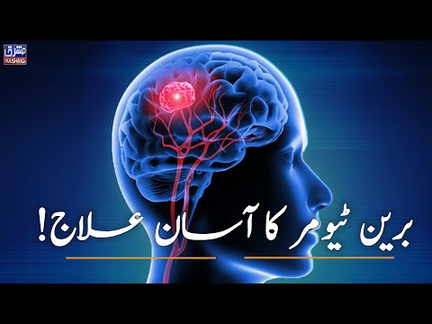 Brain tumours ka asaan ilaaj!