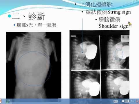 小兒外科衛教5 胃幽門阻塞手術