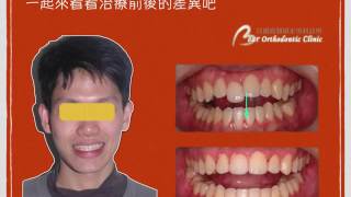 貝爾齒顎矯正日記~我不要再當戽斗哥啦不手術戽斗矯正  x-bite class III malocclusion