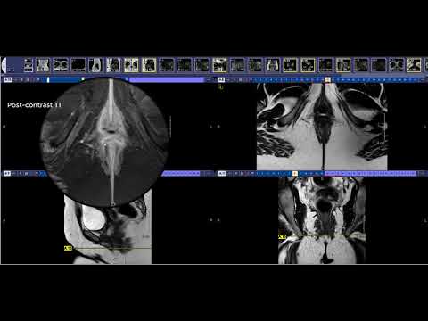 how to read an anal fistula mri