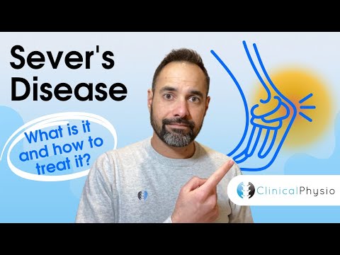 Severs disease | Expert Physio Guide