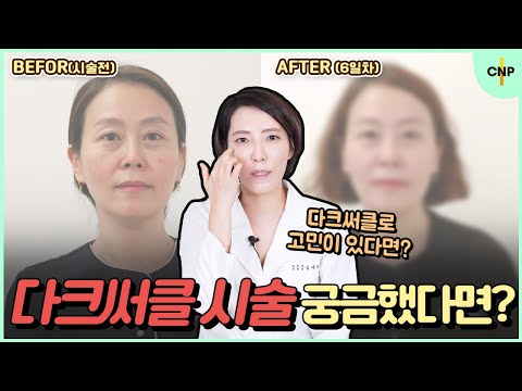 다크써클 시술과정 보여드립니다! 짙어진 눈 밑 밝게 만드는 방법! [다크써클 2탄]