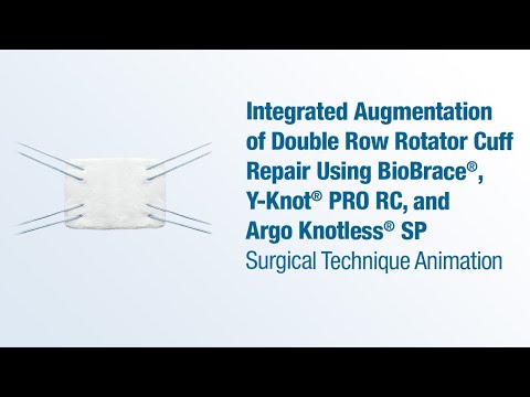 Augmentation of a Double Row RCR using BioBrace®, Y-Knot® PRO RC, and Argo Knotless® SP - CONMED