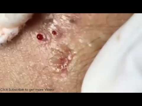 Deep Acne Remove, Milia, How To Rid Of Pimples 2019