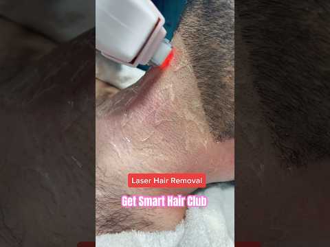 Laser Hair Removal