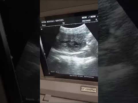 women pelvic scan #ultrasound #abdominal #health #science