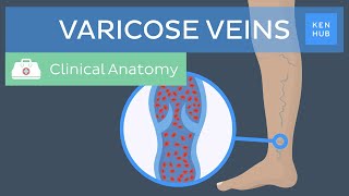 Varicose veins: Definition, causes, symptoms and treatment | Kenhub