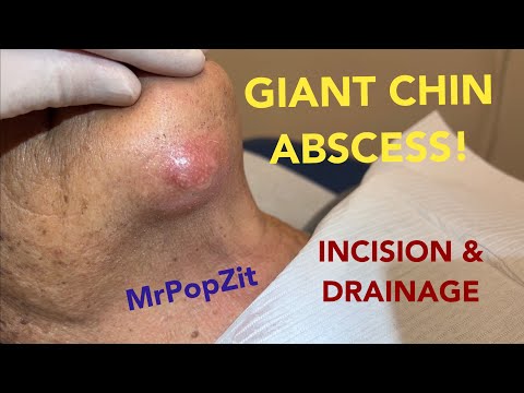 Giant inflamed tender abscess on chin. I open it and drain it.