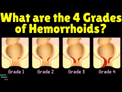 Hemorrhoids Grading | What are the 4 Grades of Hemorrhoids?