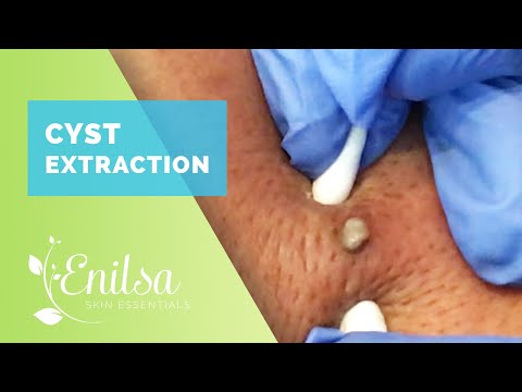 Cyst Extraction Part 1