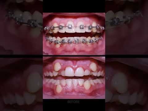 How braces work