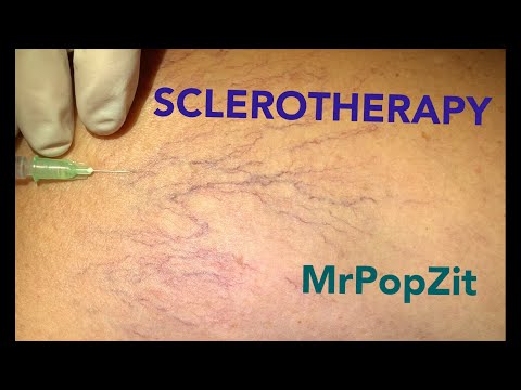 Common procedure I perform. Sclerotherapy collapses small vessels and reduces the red appearance