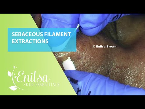 Sebaceous Filament Extractions