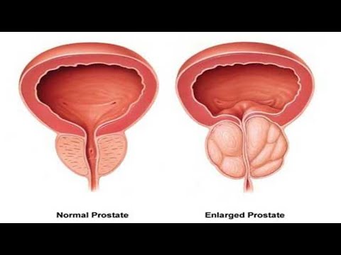 Top 10 Best Foods to Shrink an Enlarged Prostate