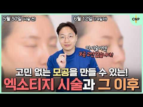 피부 나이를 거꾸로 돌린다는 리버스에이징! 엑소티지와 프락셀을 이용한 모공치료 방법!