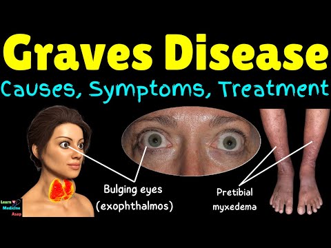 Graves Disease – Causes, Symptoms, Diagnosis and Treatment | Graves Disease Explained