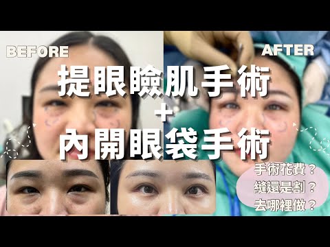 花14萬做提眼瞼肌手術+割雙眼皮+眼袋內開手術全記錄 Vlog｜晶華美醫陳瑋農醫師｜I'm Tammy,s媽，布農媳婦記露趣🏕