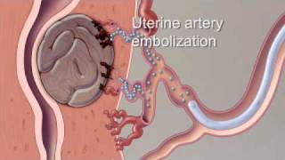 Fibroid Treatment Options - Mayo Clinic