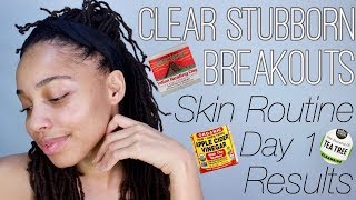 Aztec Secret Indian Healing Clay | Keep Breakouts Away