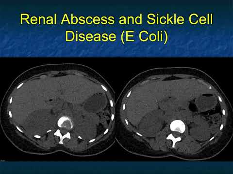 The Differential Diagnosis of Loss of Renal Corticomedullary Interface - Part 2