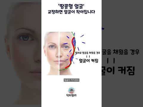 광대 크고 볼이 꺼진 땅콩형 얼굴! 교정해서 작고 매끄럽게!!  #데이원클리닉강남본점 #beauty