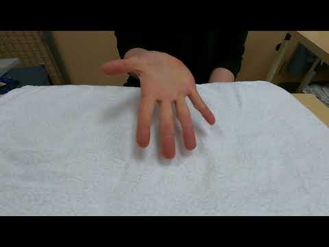 Hand injury exercise 1: Active full finger bending and straightening (flexion and extension)