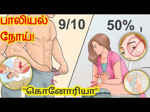 கொனோரியா பாலியல் நோய்/Gonorrhea in tamil/Gonorrhea symptoms in tamil/Gonorrhea treatment in tamil