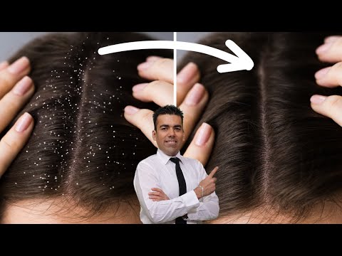 Dandruff? What is its root cause and how to handle it with home remedies?