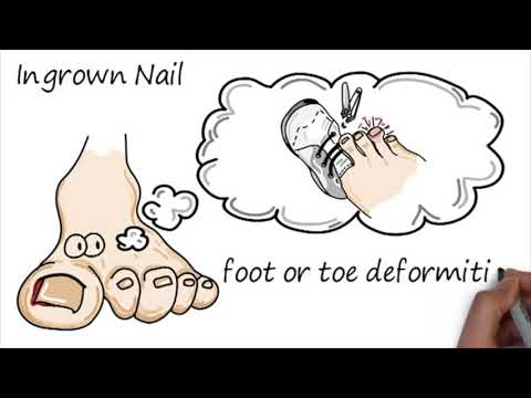 Pediatric Ingrown Toenail Treatment   Dr  Jarman, DPM Phoenix