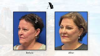 Ageless Elegance - The Art of Facelifts | Paul N. Afrooz, MD