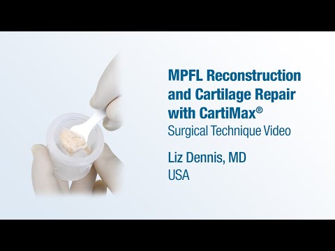 Dr. Liz Dennis - MPFL Reconstruction and Cartilage Repair Using CartiMax® - CONMED Technique