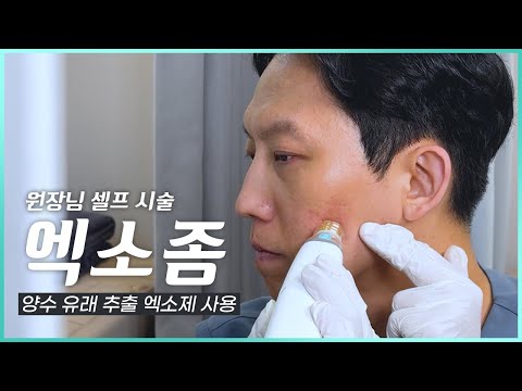 엑소좀(양수 유래 엑소제) 셀프 시술 해보기 (with 포텐자, MTS레이저 펌핑팁)