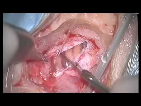 Trigeminal interfascicular neurolysis (nerve combing) forrefractory recurrent neuralgia in MS