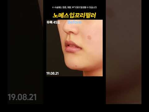 아름다운 미소로! 로렌의 노메스 입꼬리 필러