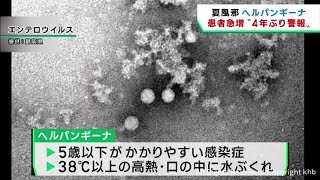 夏風邪の一種ヘルパンギーナ患者が急増　宮城県が警報を出し感染予防徹底を呼び掛け