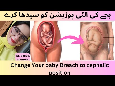 Flip breech baby position|Baby ki ulti position ko seedh kaisy kreबेबी की उल्टी पोजीशन को कैसे सीखें