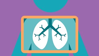 Low Dose Computed Tomography (LDCT)