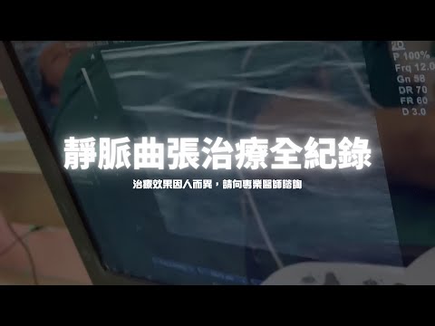 靜脈曲張治療全紀錄（六步驟）-極緻美型·文心極緻美型皮膚科診所整形手術-林子鈞醫師：靜脈曲張_台中靜脈曲張_硬化劑_雷射治療_注射治療