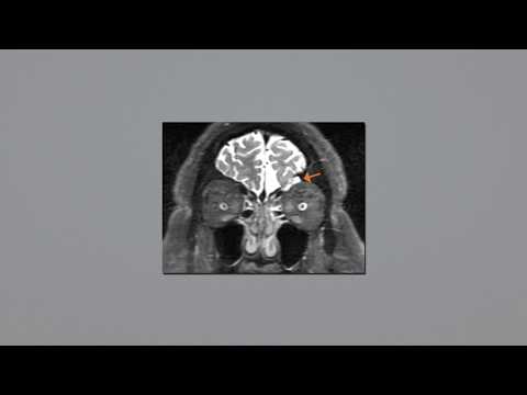 Transorbital approach for endoscopic repair of encephalocele