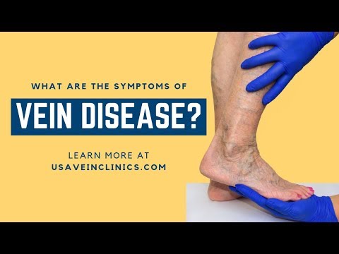 The Symptoms of Vein Disease