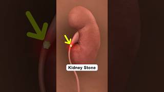 5 Foods that Cause Kidney Stones  #kidneydisease #kidneystone #kidney