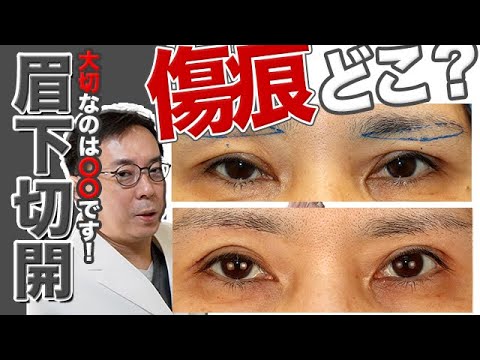 【眉下切開】圧倒される傷跡の目立たなさ！修正も多くこなす美容外科医師のこだわりを徹底解剖