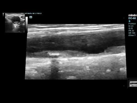 Tandem plaques in common carotid artery #shortsvideo