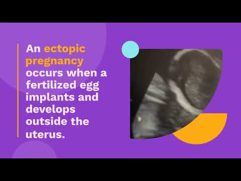 Ectopic pregnancy #pregnancy #ultrasound #sonographer #health #anatomy